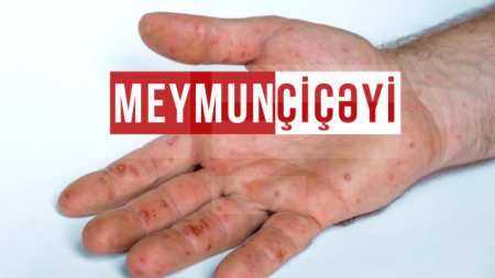 Dünyada meymunçiçəyinə yoluxma hallarının sayı 50 min nəfəri keçib