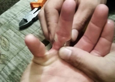 Bakıda 1 nəfərin barmağında dəmir halqa qaldı